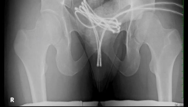 Homem é internado após enfiar cabo USB no pênis e objeto ficar preso
