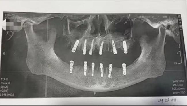 Homem morre após cirurgia para extrair 23 dentes e implantar outros 12 no mesmo dia