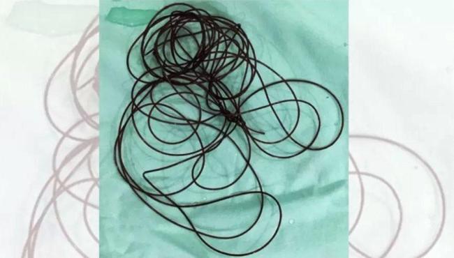 Homem passa por cirurgia ao inserir cabo de nylon de 2 metros no pênis