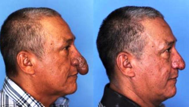 Homem que tinha ‘pênis’ no nariz opera nos EUA: “Presente de natal”