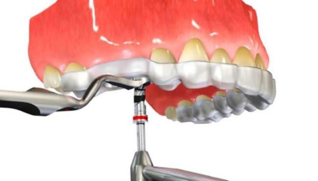 Implantes sem cortes? entenda como é a cirurgia guiada, na odontologia