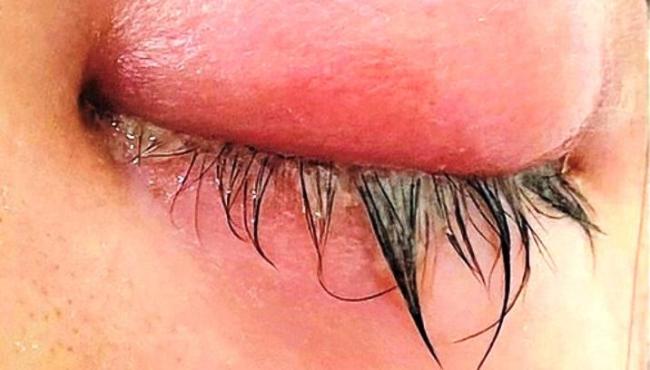 Infecção sexualmente transmissível pode afetar os olhos; saiba como se proteger