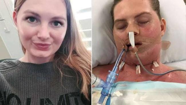 Inflamação de siso quase mata e deixa mulher de 23 anos em coma
