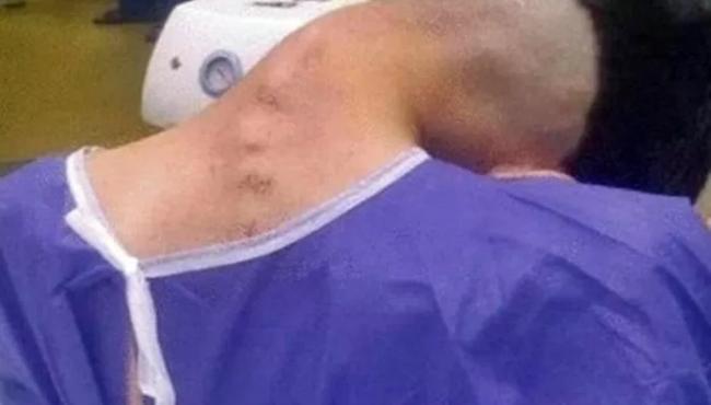 Irã registra caso raro de síndrome da cabeça caída por uso de drogas