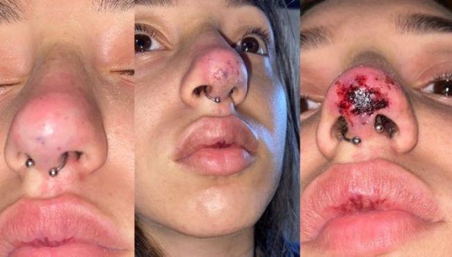 Jovem fica com o nariz necrosado após procedimento estético malsucedido