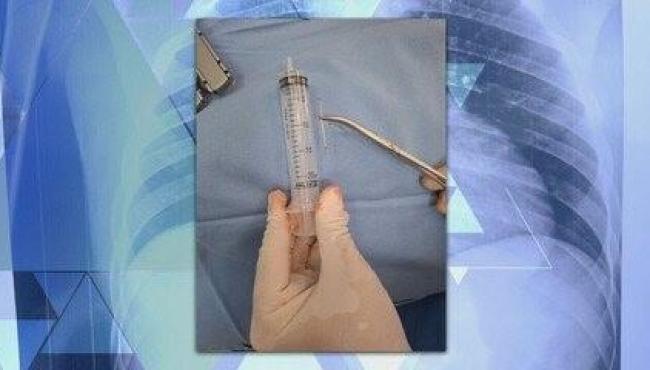 Jovem sobrevive à cirurgia para retirar prego cravado no coração: ‘Nasci de novo’