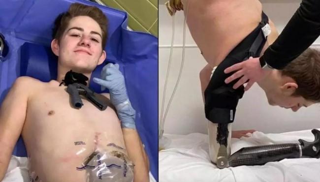 Jovem tem corpo cortado ao meio por empilhadeira e mostra como vive após acidente