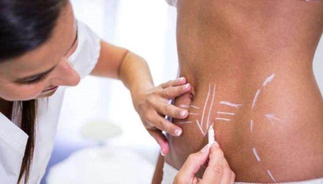Lipoaspiração e abdominoplastia não são tratamentos para perder peso, alerta especialista