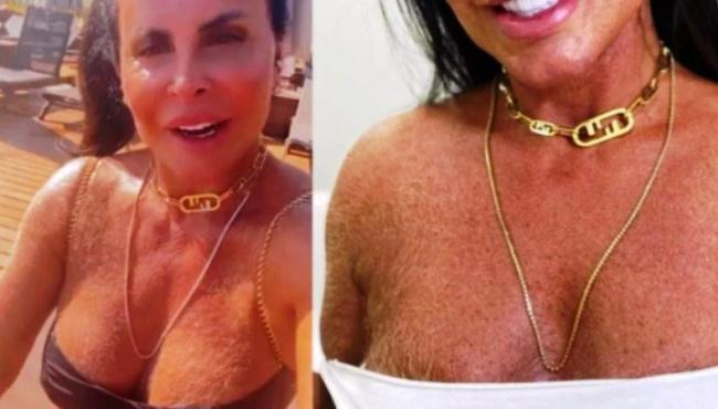 Médico explica possíveis causas de peito e braços peludos de Gretchen