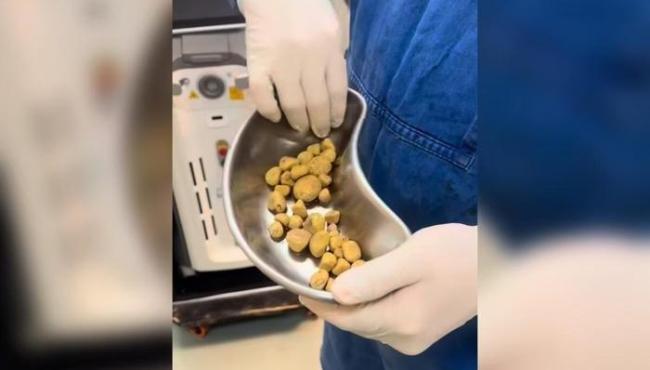 Médico retira 35 pedras da bexiga de homem viciado em refrigerante