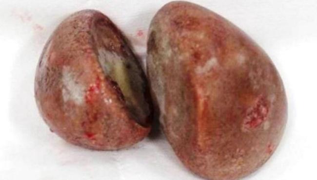 Médicos descobrem pedras ‘gigantes’ na vagina de paciente