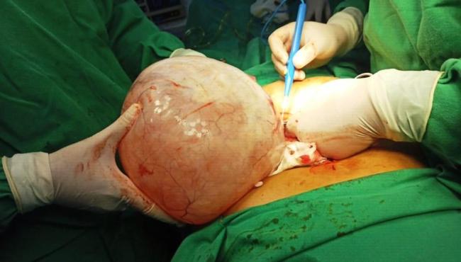 Médicos retiram cisto de 5 kg do ovário de idosa durante cirurgia de emergência
