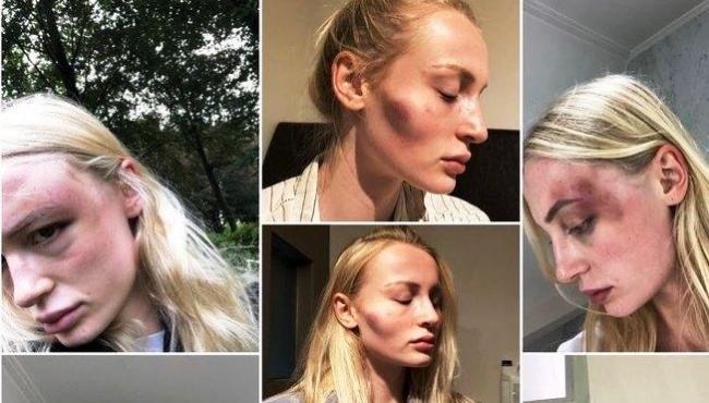 Modelo expõe ferimentos após ser agredida por ex-namorado: "Sorte de estar viva"