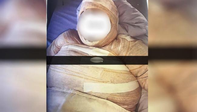 Mulher é presa suspeita de atear fogo na namorada por ciúmes
