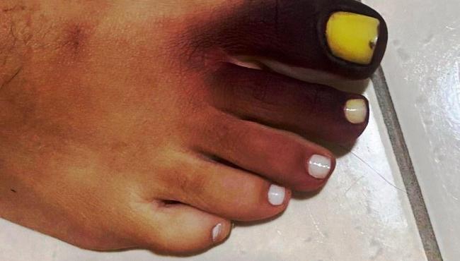 Mulher fica com pé roxo e unha amarela ao calçar tênis com piolho-de-cobra