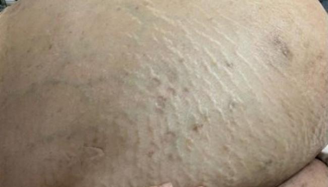 Mulher pensou que estava engordando, mas tinha um tumor de 46 kg; entenda o caso