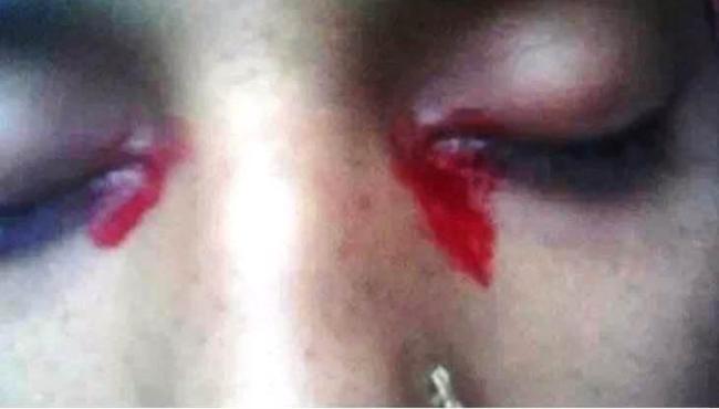 Mulher que ‘chora’ sangue intriga pessoas do mundo inteiro, mas possível causa é revelada