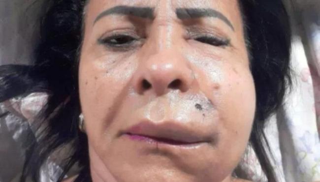 Mulher retira 40 nódulos do rosto após harmonização facial