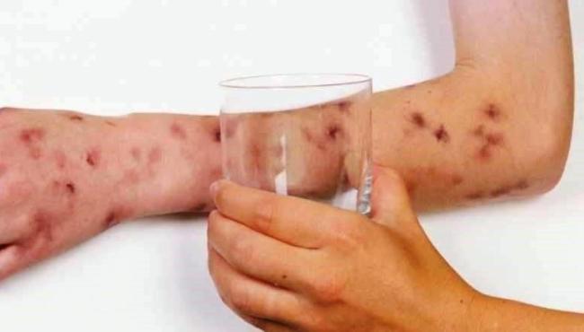 Número de mortes e casos de meningite cresce no ES; veja quais são os sintomas
