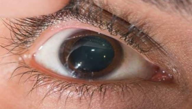 Oftalmologistas alertam para risco de suplementos com promessa de cura