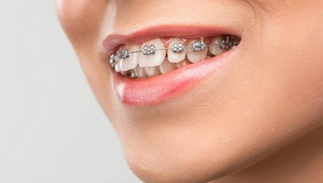 Os dentes podem ser danificados com o aparelho ortodôntico? Entenda