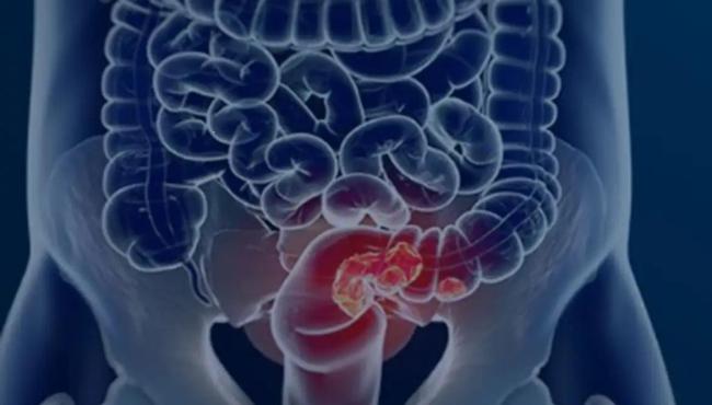 Pacientes com câncer colorretal são diagnosticados em estágio avançado