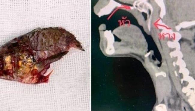 Peixe pula direto para a boca de pescador e acaba preso entre a garganta e a cavidade nasal