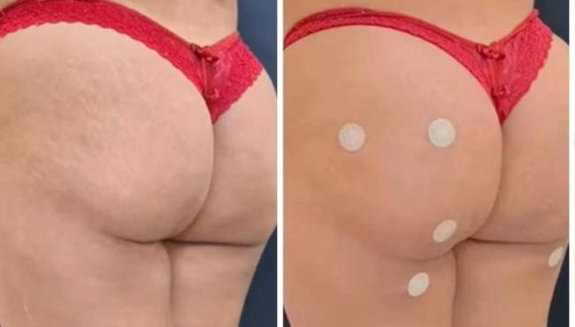Preenchimento de bumbum vira febre no ES: ‘Elimina celulite’