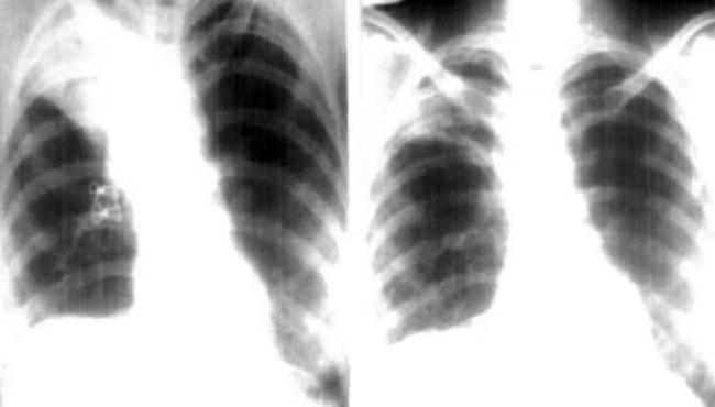 Professora com suspeita de tuberculose faz raio-X e médicos descobrem camisinha dentro dos pulmões