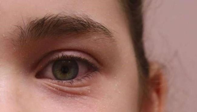Sintomas de rinite vão além dos espirros: Aprenda a identificar o problema