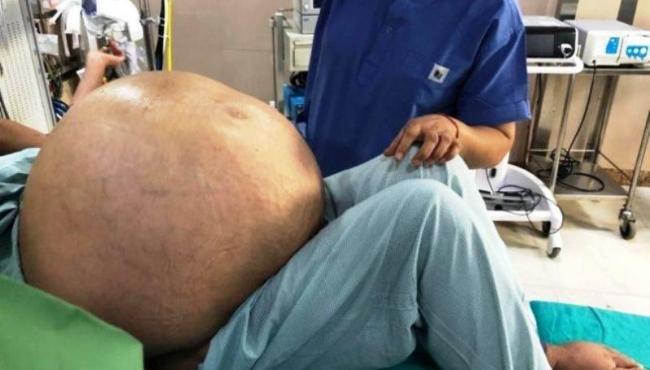 Tumor ovariano de 50 kg é removido de mulher em cirurgia