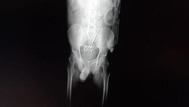 Vereador tem tesoura 'esquecida' dentro do corpo, após cirurgia no intestino