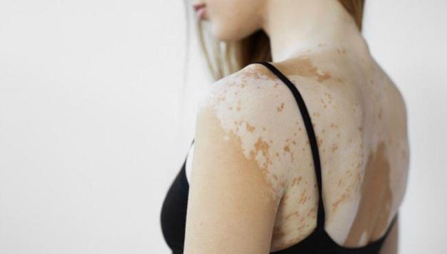 Vitiligo: confira dicas de cuidados especiais com a pele