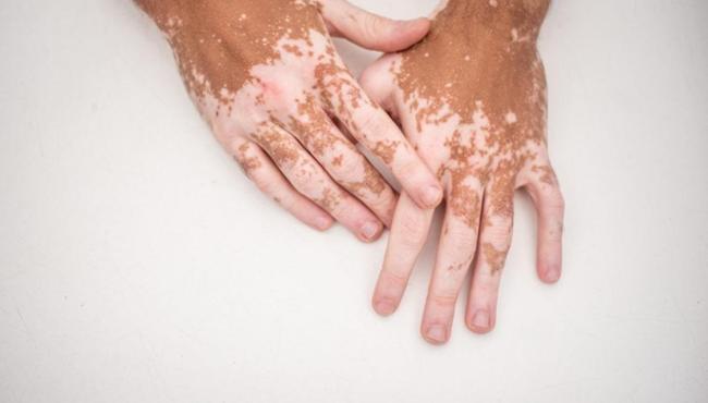 Vitiligo: conheça os sintomas, tratamento e impacto da doença
