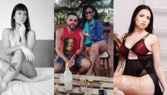 Vitiligo: “Ouvia das pessoas que era bonita, pena que tinha a pele manchada”